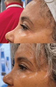 Cryofacial carboxytherapy treatment in Yakima