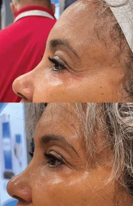 Cryofacial carboxytherapy treatment in Yakima