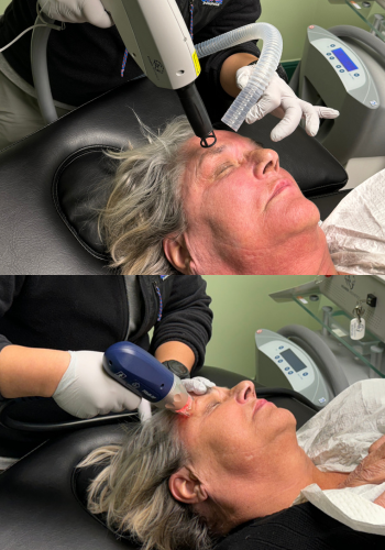 Non-Surgical Facelift Treatment in Yakima
